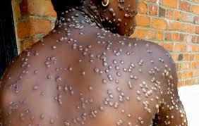 Variole du singe au Sénégal : 25 cas contacts sous surveillance médicale